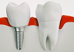 Single dental implant in Farmington, MI next to natural tooth