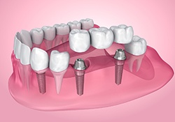 Illustration of dental bridge being attached to dental implants in Farmington, MI