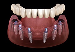 Full denture being attached to dental implants in Farmington, MI