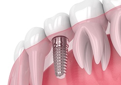Illustration of dental implant in Farmington, MI with crown